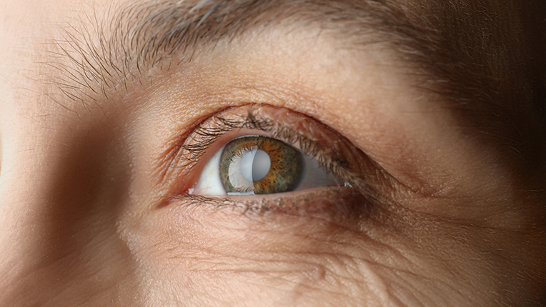 Eyelid Eyebag Surgery