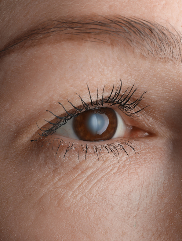 Eyelid Eyebag Surgery